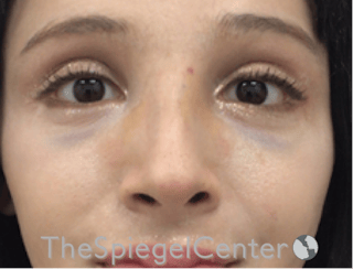 Revision Rhinoplasty Before & After Gallery - Patient 485659 - Image 4