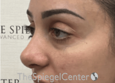 Revision Rhinoplasty Before & After Gallery - Patient 265562 - Image 2