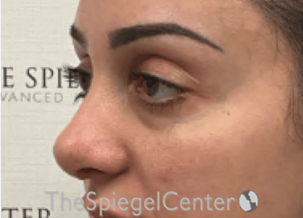 Revision Rhinoplasty Before & After Gallery - Patient 265562 - Image 2