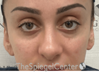 Revision Rhinoplasty Before & After Gallery - Patient 265562 - Image 3