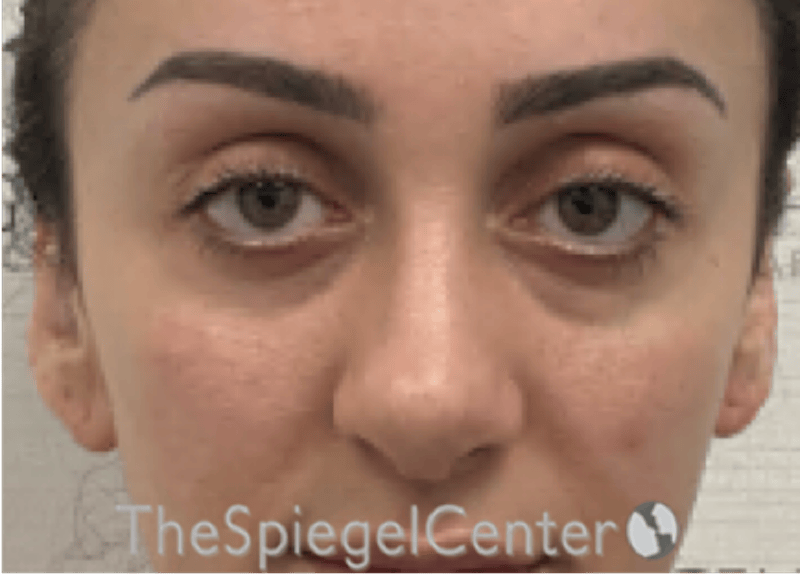 Revision Rhinoplasty Before & After Gallery - Patient 265562 - Image 4