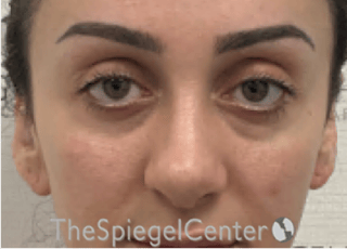 Revision Rhinoplasty Before & After Gallery - Patient 265562 - Image 4