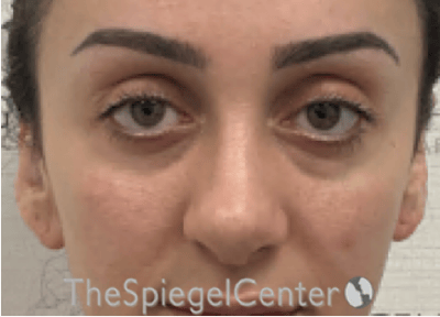 Revision Rhinoplasty Before & After Gallery - Patient 265562 - Image 4