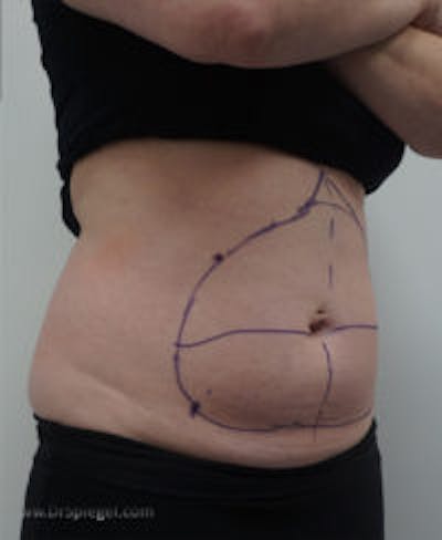 Bodytite Before & After Gallery - Patient 304759 - Image 5