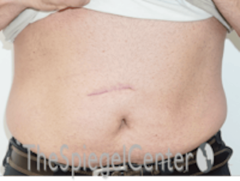 Bodytite Before & After Gallery - Patient 764209 - Image 1
