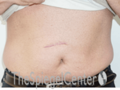 Bodytite Before & After Gallery - Patient 764209 - Image 1