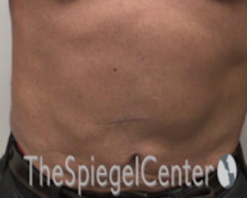 Bodytite Before & After Gallery - Patient 764209 - Image 2