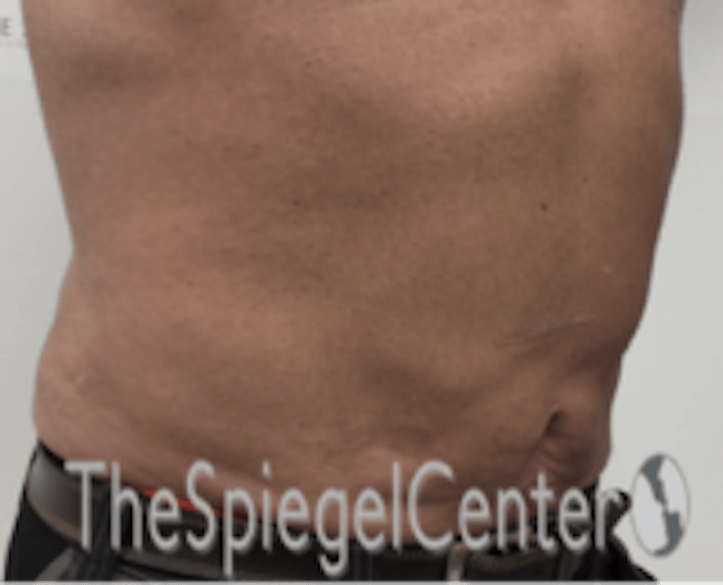 Bodytite Before & After Gallery - Patient 764209 - Image 4