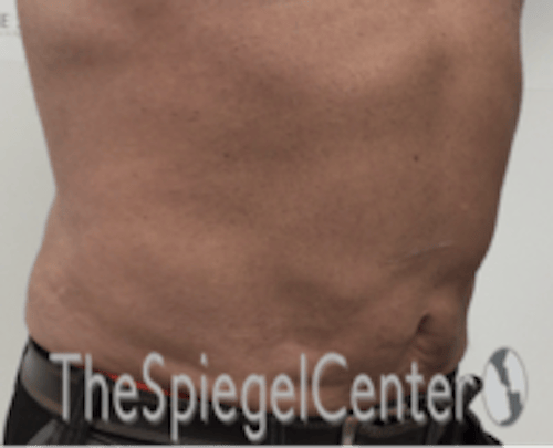 Bodytite Before & After Gallery - Patient 764209 - Image 4