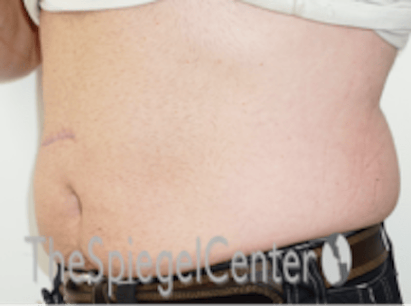 Bodytite Before & After Gallery - Patient 764209 - Image 5