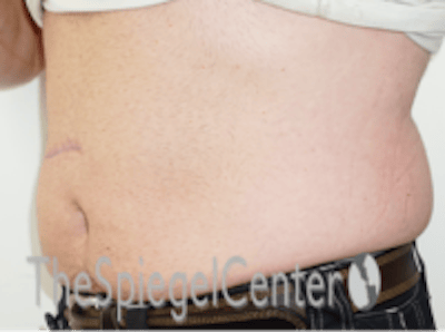 Bodytite Before & After Gallery - Patient 764209 - Image 5