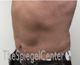 Bodytite Before & After Gallery - Patient 764209 - Image 6