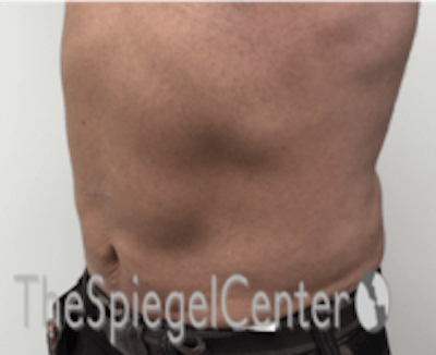 Bodytite Before & After Gallery - Patient 764209 - Image 6