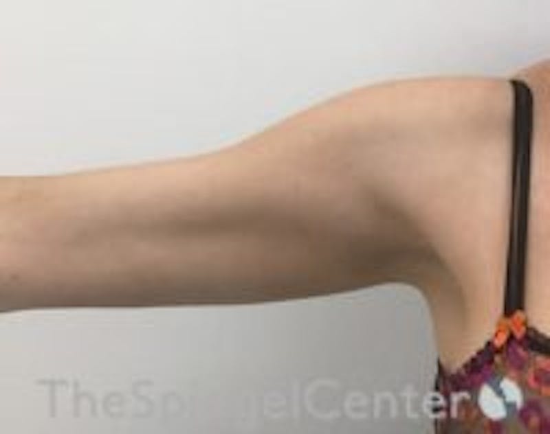 Arm Lift Before & After Gallery - Patient 306693 - Image 1