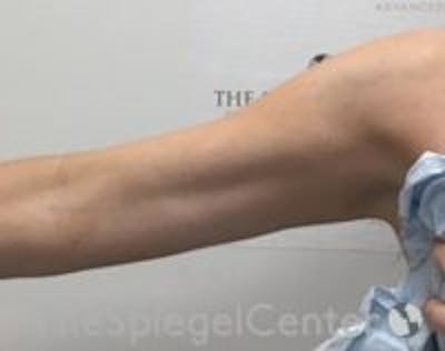 Bodytite Before & After Gallery - Patient 146240 - Image 2