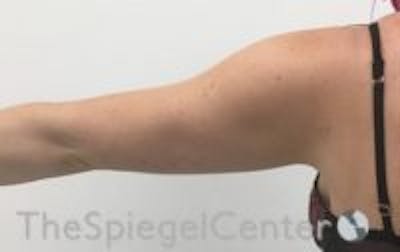 Bodytite Before & After Gallery - Patient 146240 - Image 3