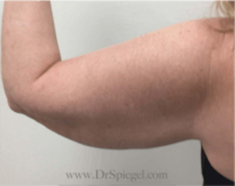 Arm Lift Before & After Gallery - Patient 157135 - Image 3