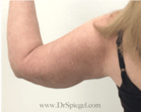 Bodytite Before & After Gallery - Patient 345772 - Image 4