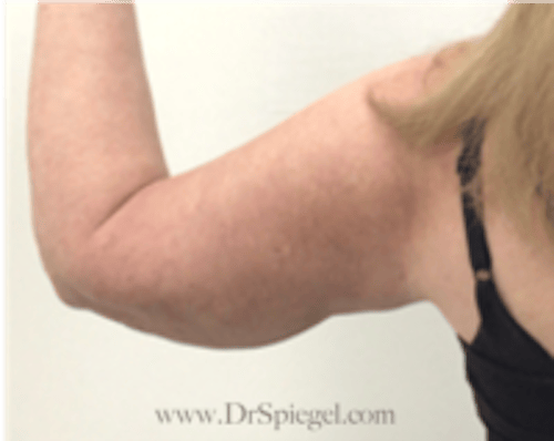 Bodytite Before & After Gallery - Patient 345772 - Image 4