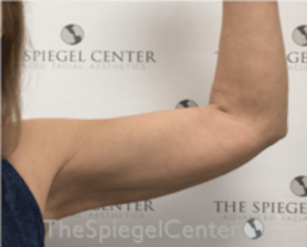 Arm Lift with BodyTite