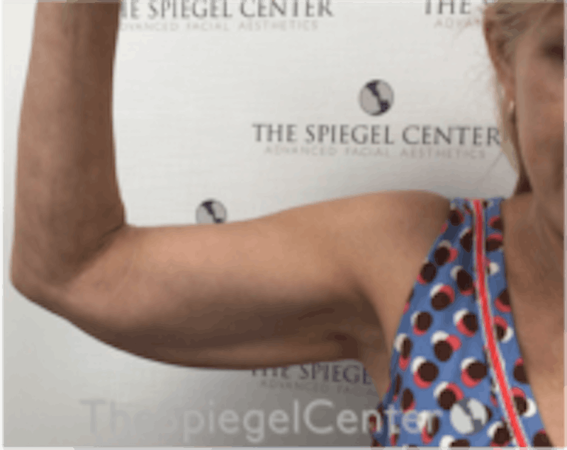 Bodytite Before & After Gallery - Patient 229771 - Image 3