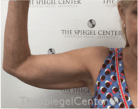 Bodytite Before & After Gallery - Patient 229771 - Image 3