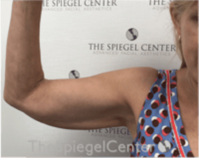 Bodytite Before & After Gallery - Patient 229771 - Image 3