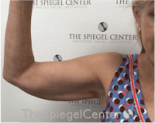 Bodytite Before & After Gallery - Patient 229771 - Image 3