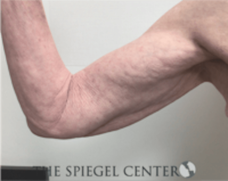 Arm Lift Before & After Gallery - Patient 113648 - Image 1