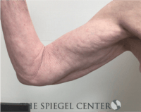 Bodytite Before & After Gallery - Patient 402401 - Image 1