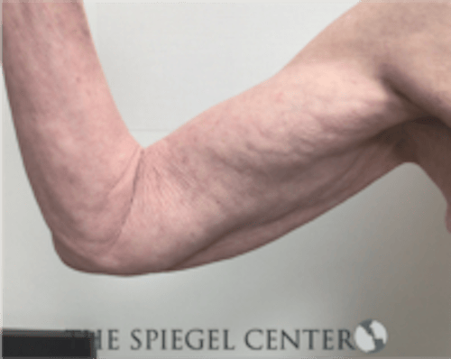 Bodytite Before & After Gallery - Patient 402401 - Image 1