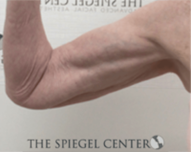 Arm Lift Before & After Gallery - Patient 113648 - Image 2