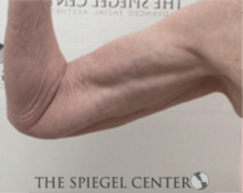 Bodytite Before & After Gallery - Patient 402401 - Image 2