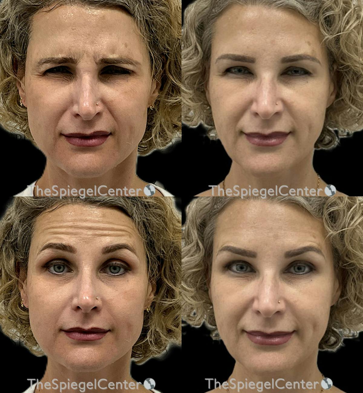 Botox / Dysport / Jeuveau / Xeomin Before & After Gallery - Patient 225984 - Image 1