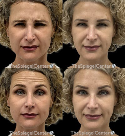 Botox / Dysport / Jeuveau / Xeomin Before & After Gallery - Patient 225984 - Image 1