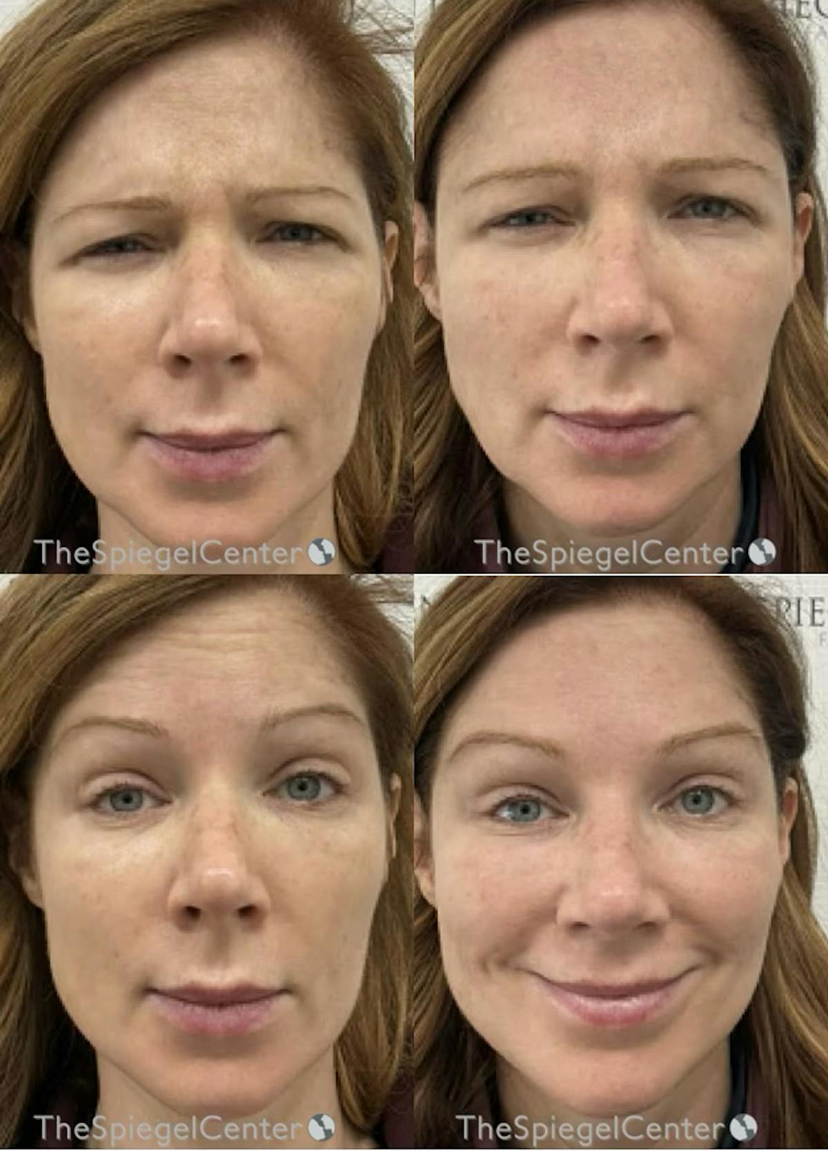 Botox / Dysport / Jeuveau / Xeomin Before & After Gallery - Patient 295854 - Image 1
