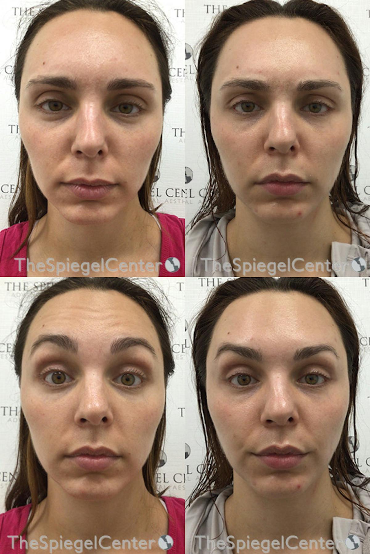 Botox / Dysport / Jeuveau / Xeomin Before & After Gallery - Patient 366331 - Image 1