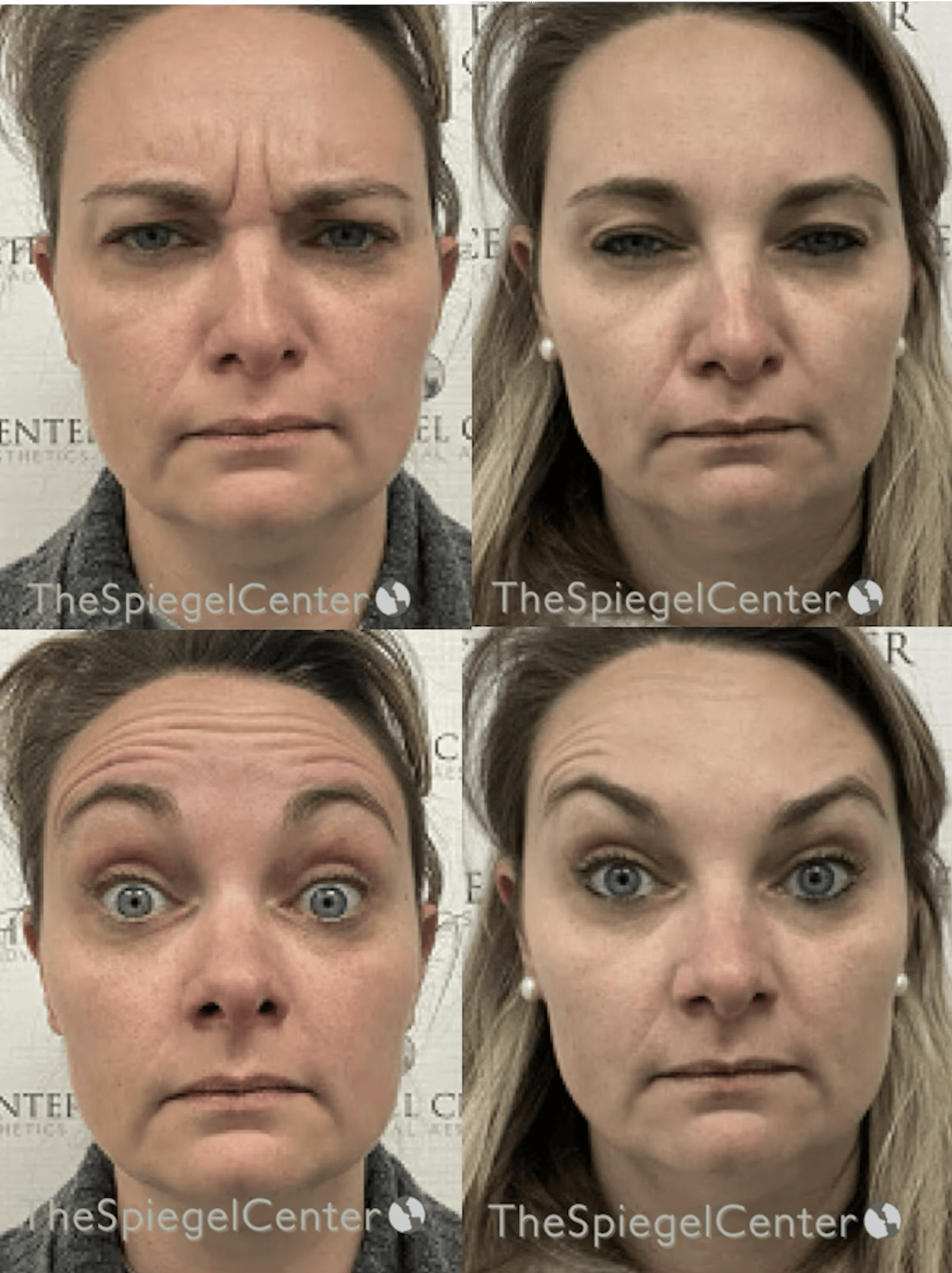 Botox / Dysport / Jeuveau / Xeomin Before & After Gallery - Patient 118841 - Image 1