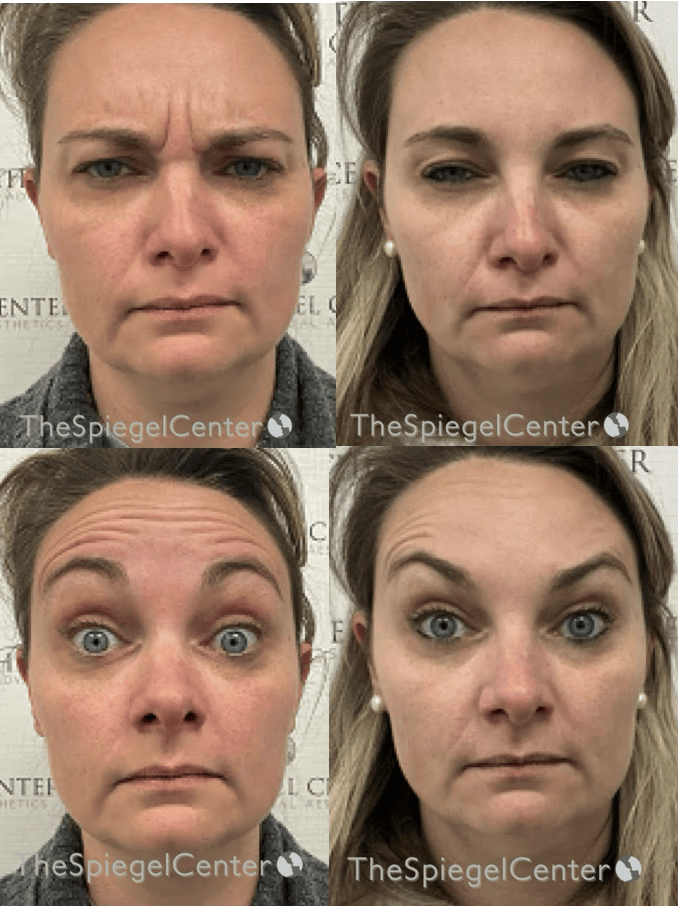 Botox / Dysport / Jeuveau / Xeomin Before & After Gallery - Patient 118841 - Image 1