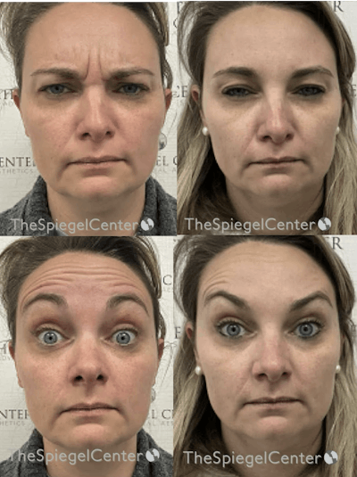 Botox / Dysport / Jeuveau / Xeomin Before & After Gallery - Patient 118841 - Image 1