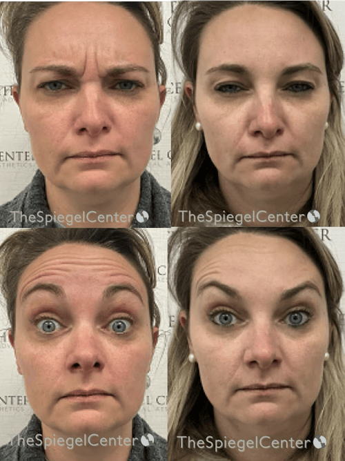 Botox / Dysport / Jeuveau / Xeomin Before & After Gallery - Patient 118841 - Image 1