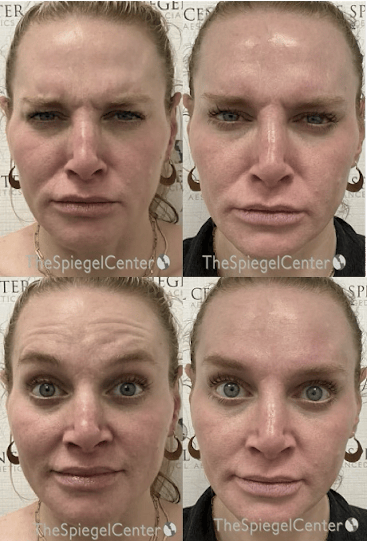 Botox / Dysport / Jeuveau / Xeomin Before & After Gallery - Patient 593318 - Image 1