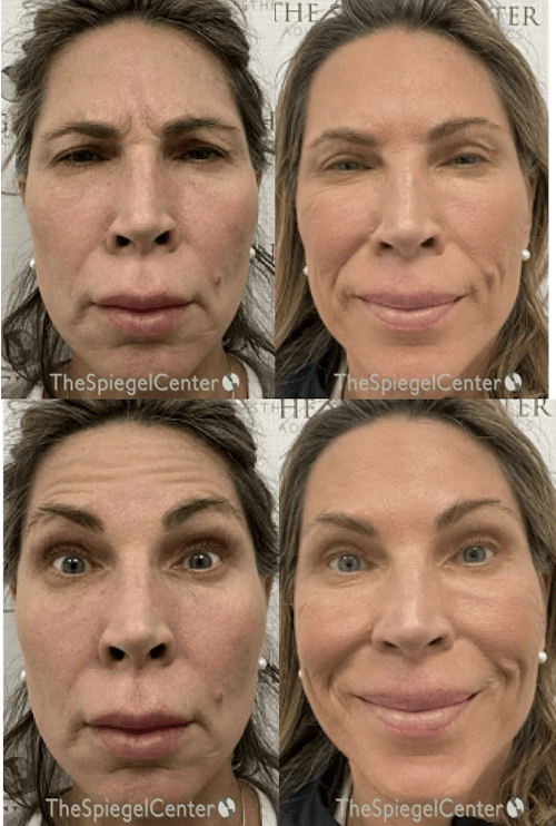 Botox / Dysport / Jeuveau / Xeomin Before & After Gallery - Patient 234927 - Image 1