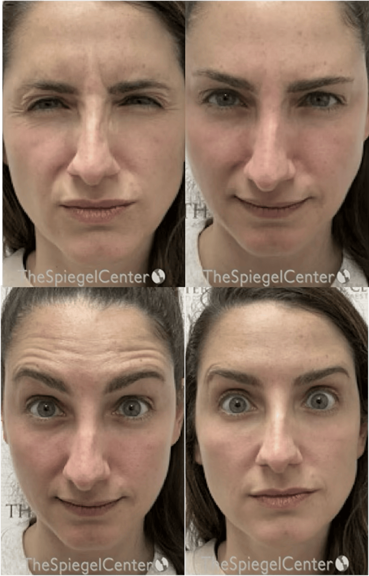 Botox / Dysport / Jeuveau / Xeomin Before & After Gallery - Patient 188048 - Image 1