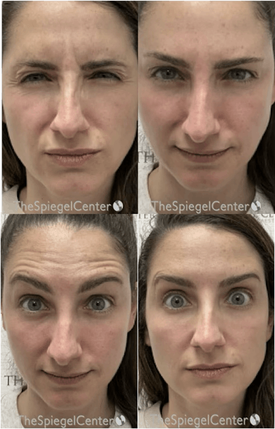 Botox / Dysport / Jeuveau / Xeomin Before & After Gallery - Patient 188048 - Image 1