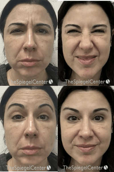 Botox / Dysport / Jeuveau / Xeomin Before & After Gallery - Patient 215236 - Image 1