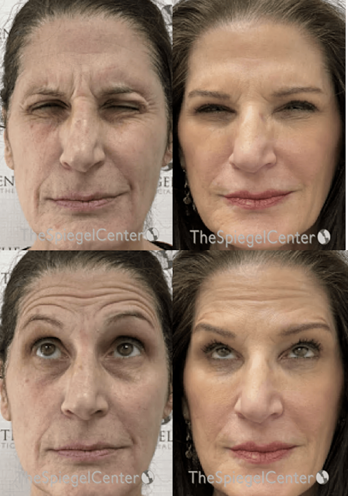 Botox / Dysport / Jeuveau / Xeomin Before & After Gallery - Patient 386256 - Image 1