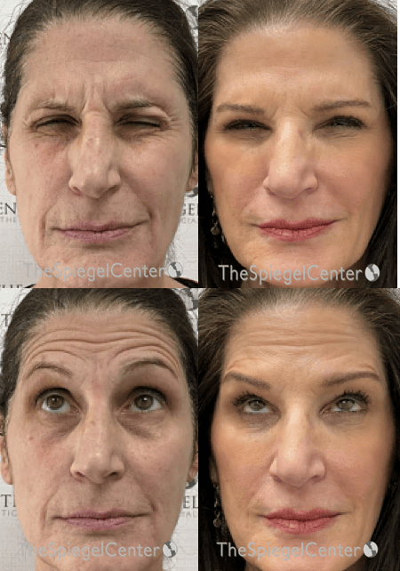Botox / Dysport / Jeuveau / Xeomin Before & After Gallery - Patient 386256 - Image 1