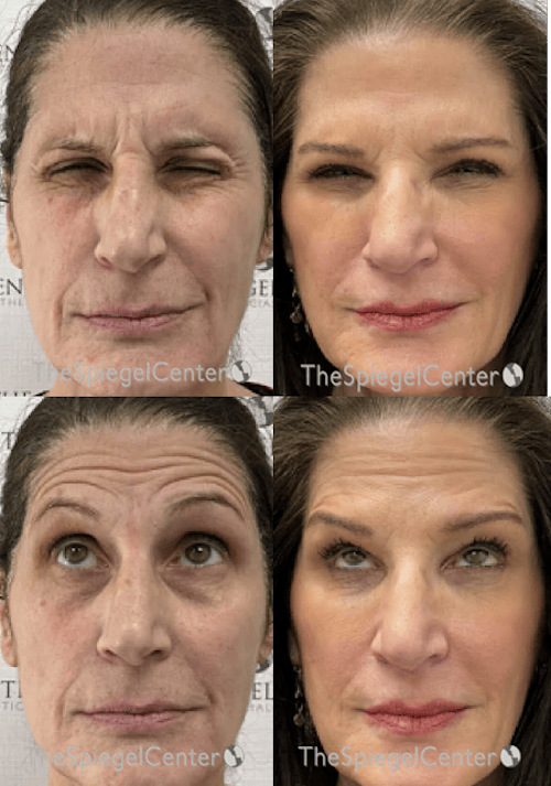 Botox / Dysport / Jeuveau / Xeomin Before & After Gallery - Patient 386256 - Image 1