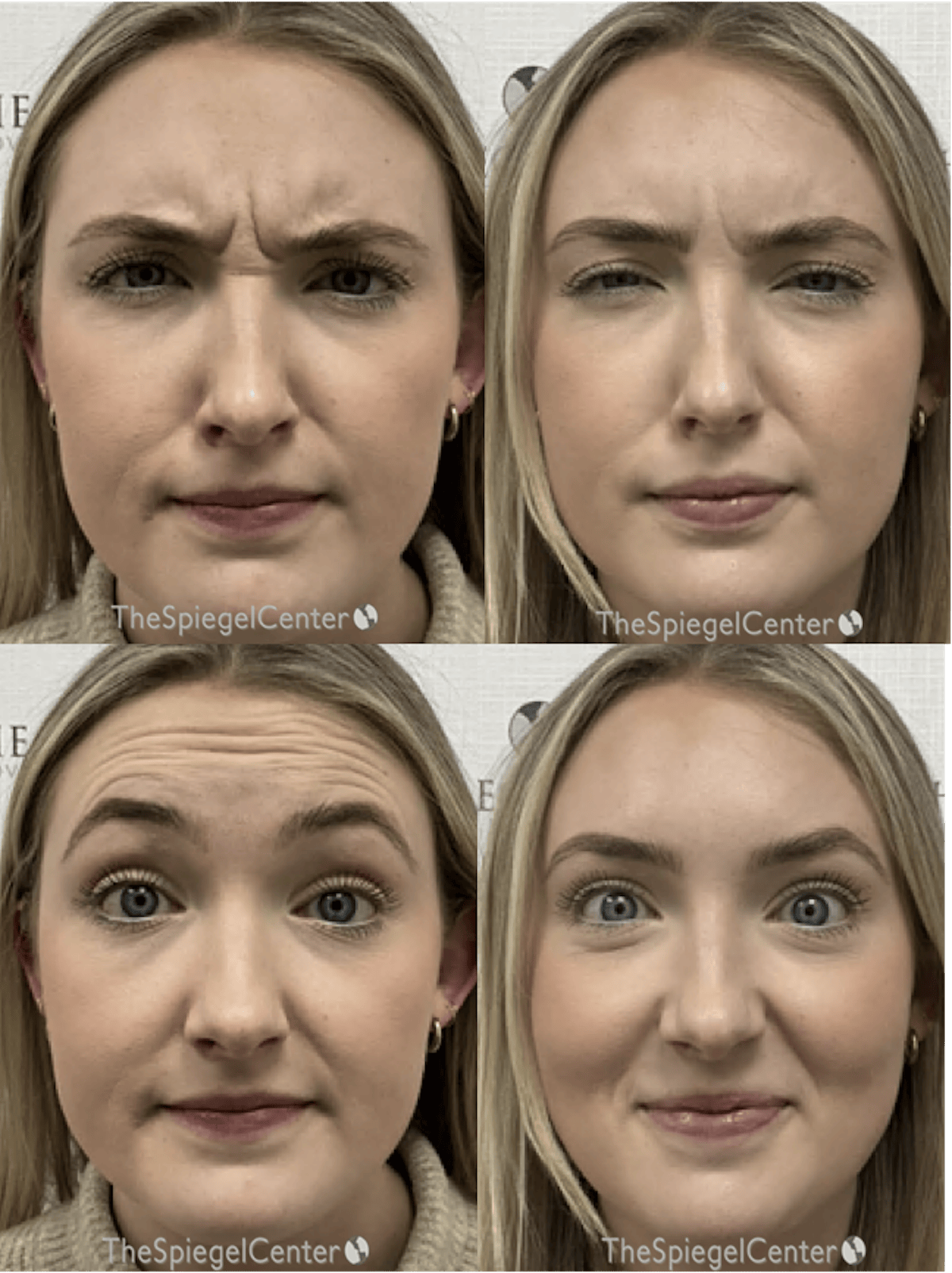 Botox / Dysport / Jeuveau / Xeomin Before & After Gallery - Patient 103490 - Image 1